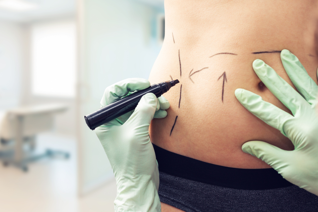 A lipoaspiração na barriga é perigosa - Clínica Infinity