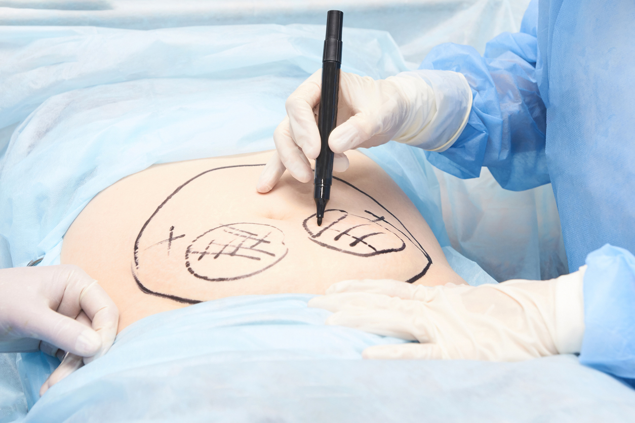 É fácil engordar depois da lipo - Clínica Infinity