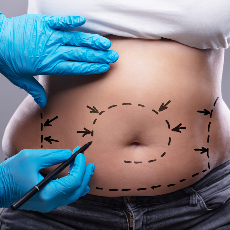 Lipoabdominoplastia