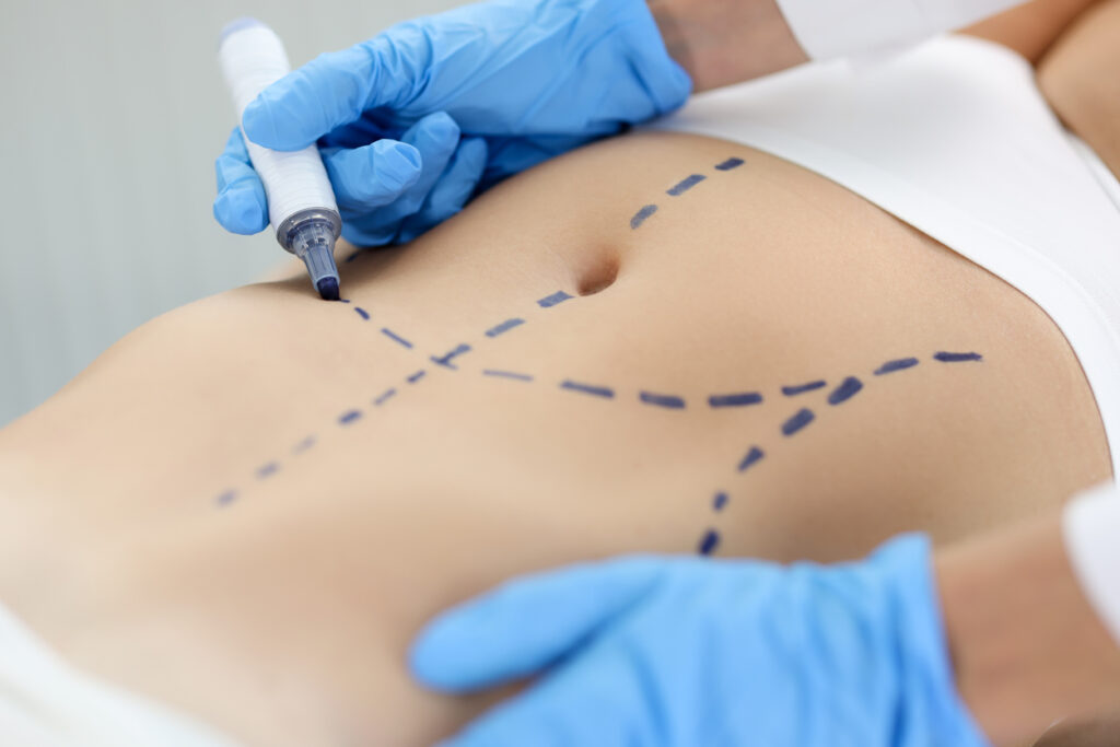 abdominoplastia sem lipoaspiração