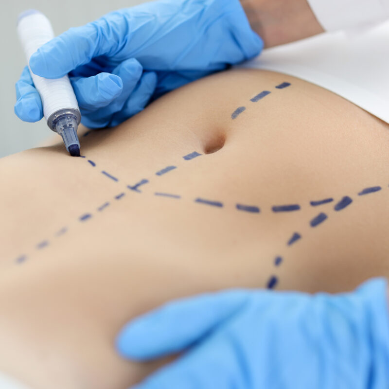 abdominoplastia sem lipoaspiração