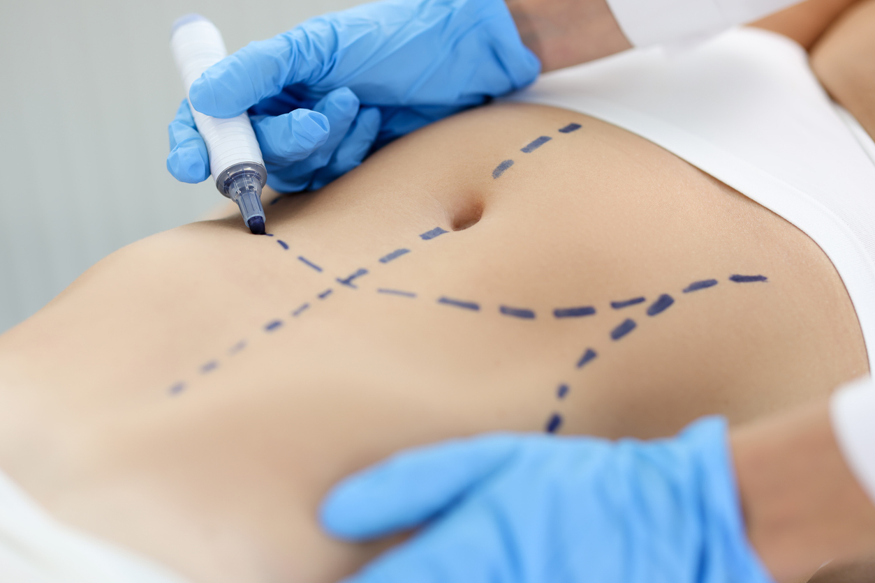 abdominoplastia sem lipoaspiração