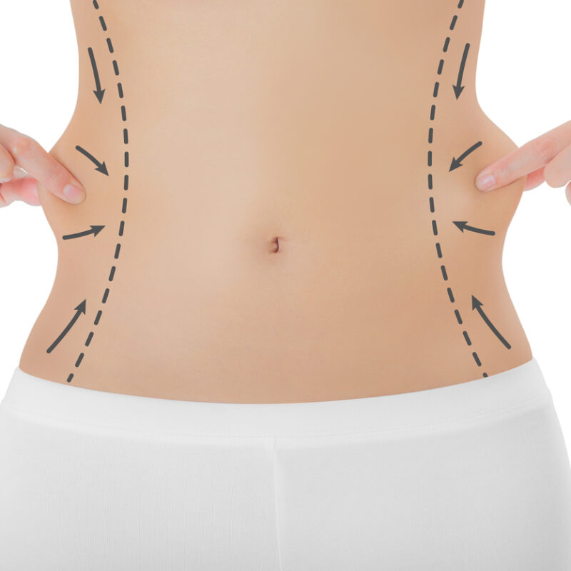 flancoplastia