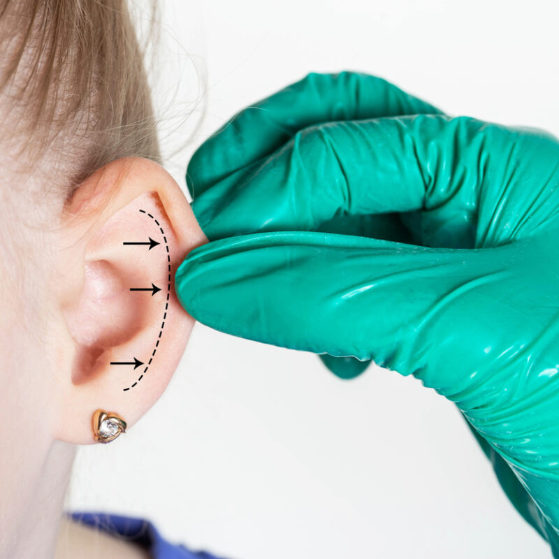 Otoplastia