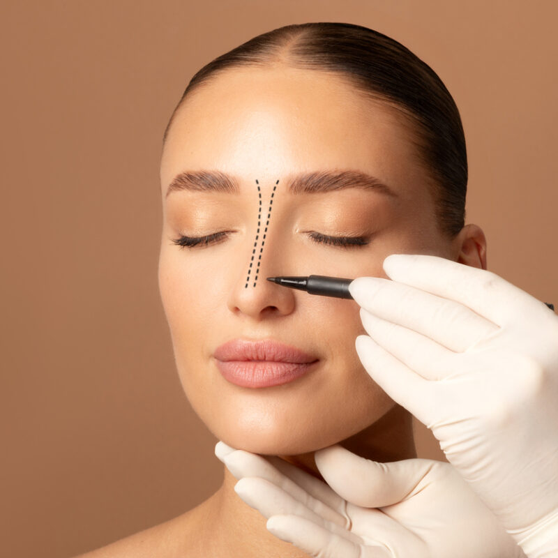 Rinoplastia