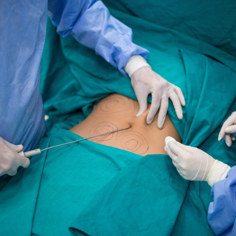 Lipoaspiração