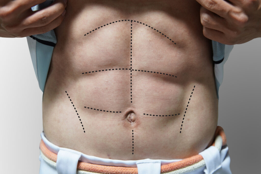 O que é lipoabdominoplastia HD?