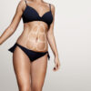 Lipoaspiração HD + Vibrolipo