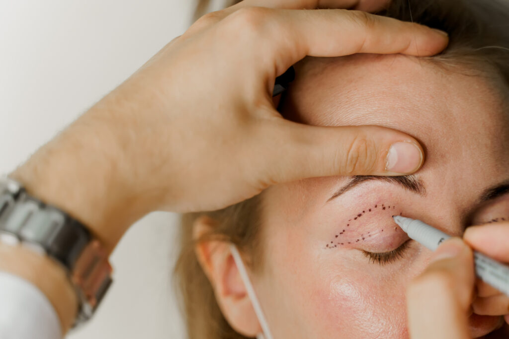 Qual é o repouso para cirurgia de pálpebras?