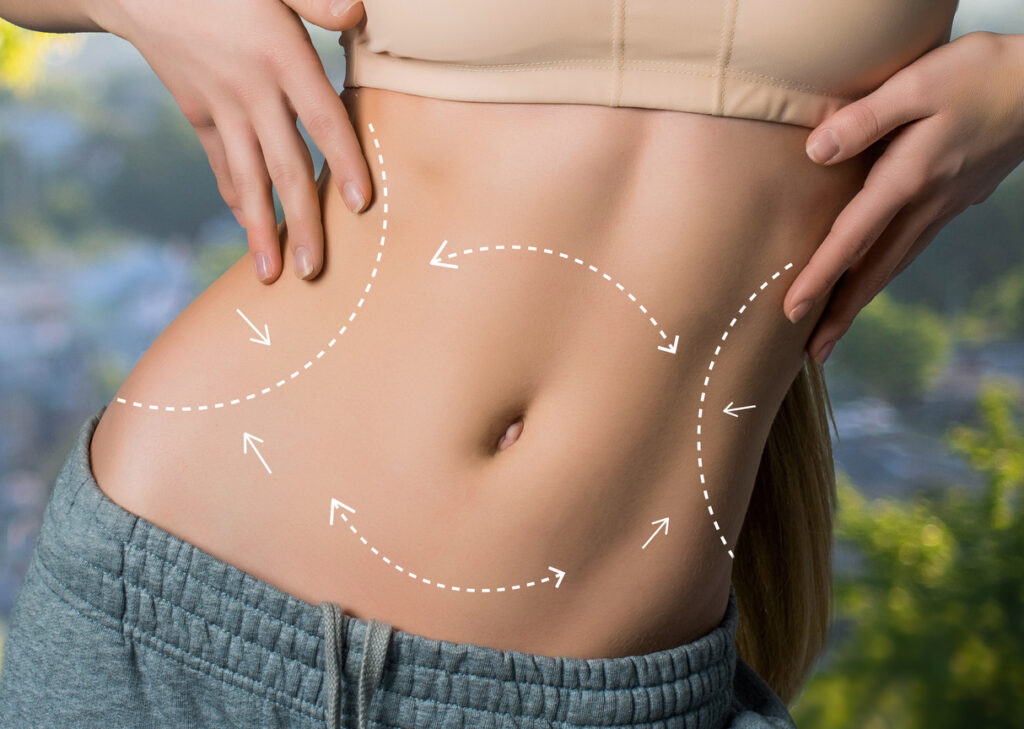 Abdominoplastia