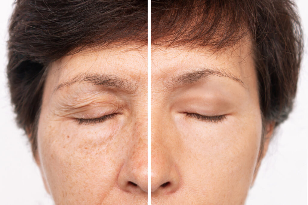 efeito da blefaroplastia