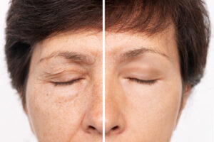 efeito da blefaroplastia
