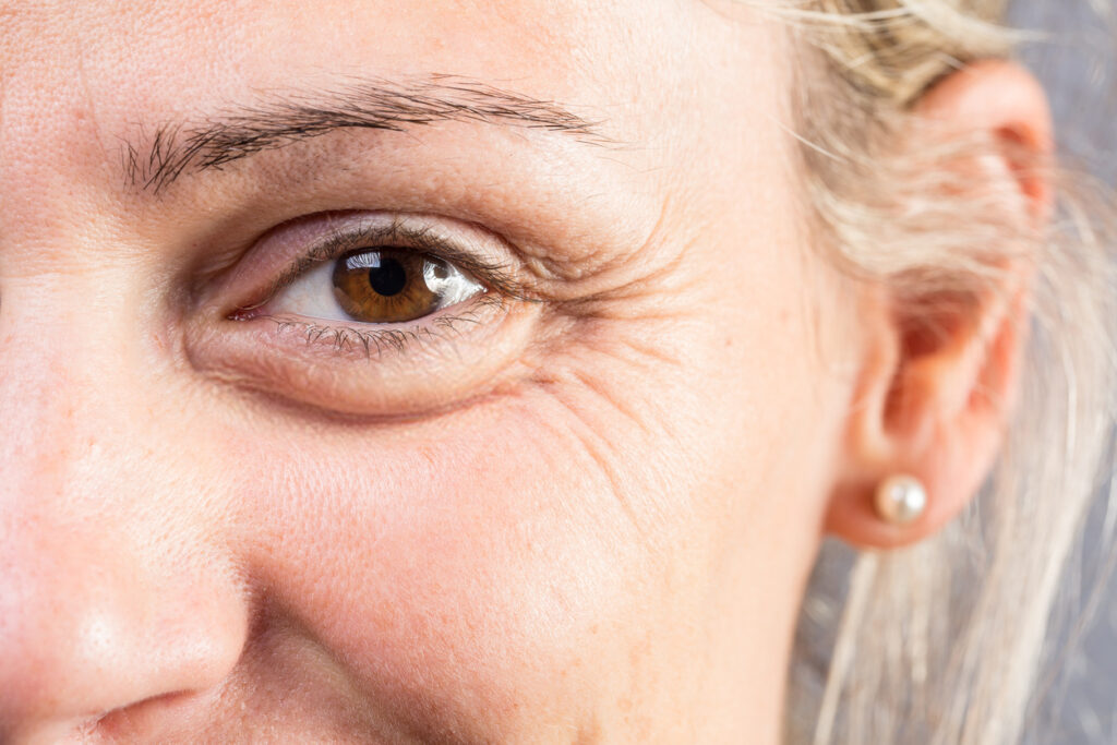 05 motivos para fazer a cirurgia de blefaroplastia