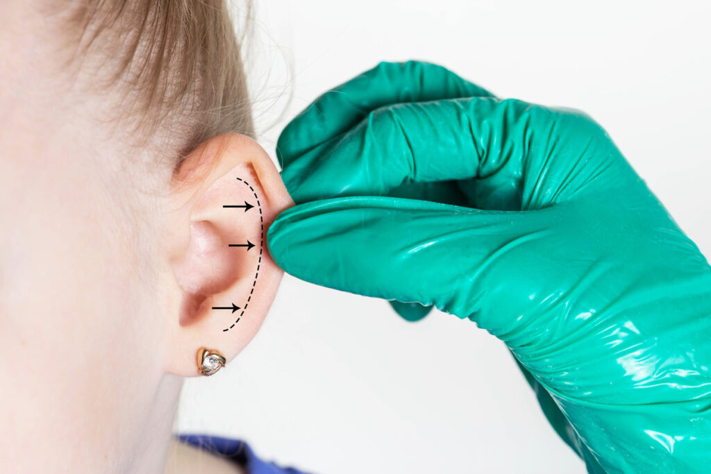 cirurgia de otoplastia