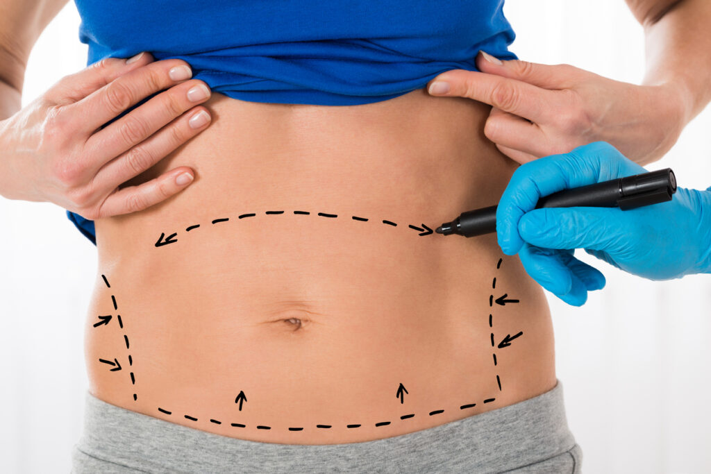 Qual o valor de uma abdominoplastia na barriga?