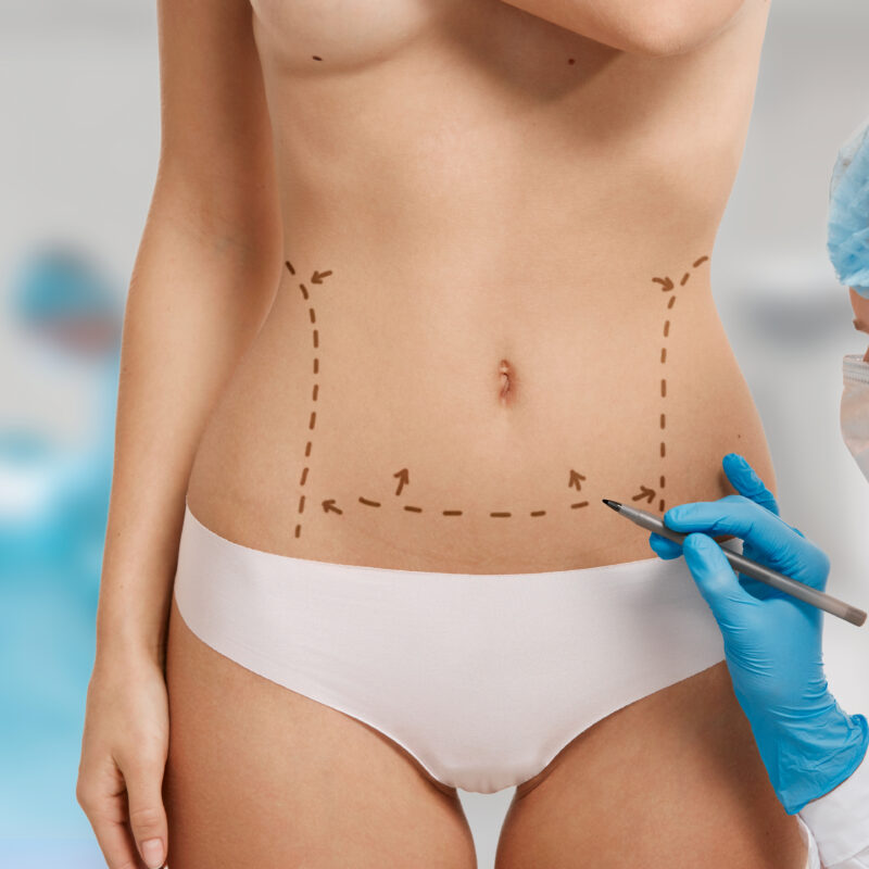 Lipoescultura HD + Vibrolipo