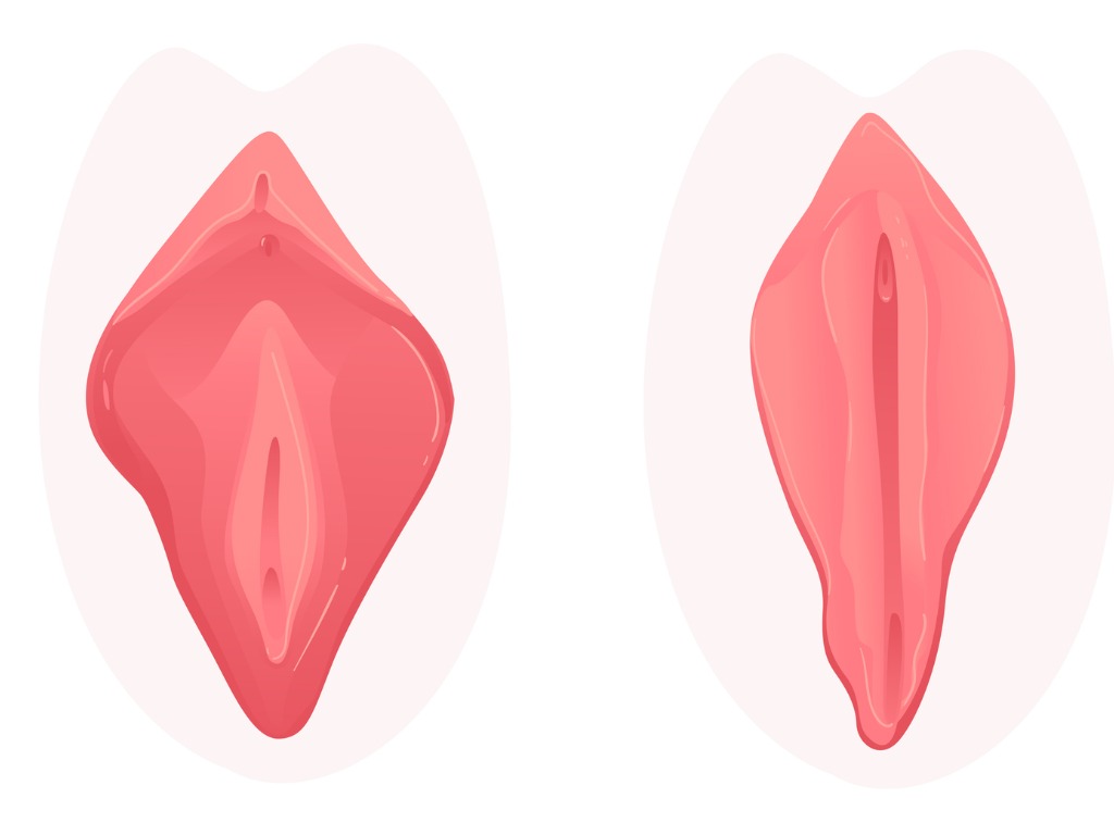 labioplastia